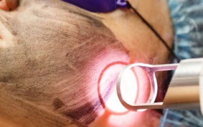 Depilación Laser Bucaramanga