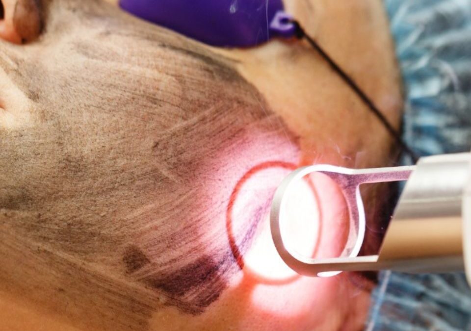 Depilación Laser Bucaramanga